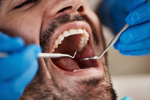 Best Emergency Dentist for Knocked-Out Tooth in Shell Point, SC