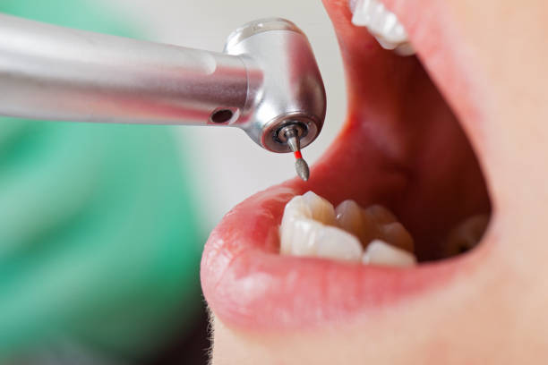 Best Emergency Root Canal Treatment in Shell Point, SC